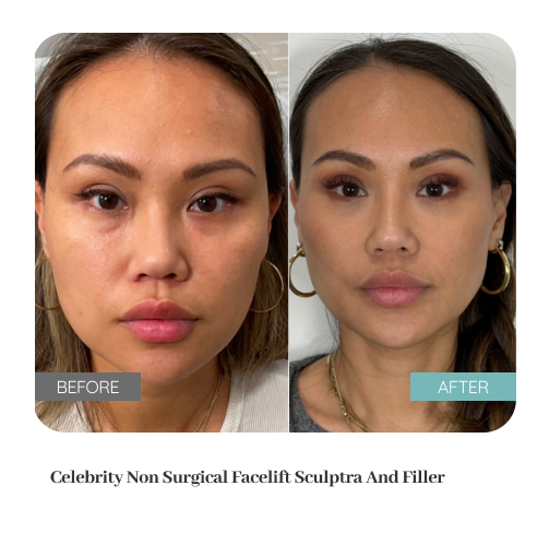Before and after treatment result — Dr. Lanna, LC Medical Aesthetics NYC